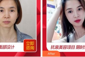 唐山聯(lián)合麗珍醫(yī)療美容門診部金承泰整形價格表附埋線提升案例展示