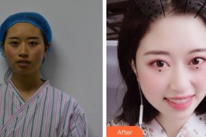 唐山星范醫(yī)療美容門診部劉勇整形價格表附埋線提升案例展示