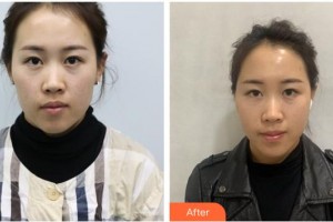 唐山祥云京城皮膚醫(yī)院張志坡整形價格表附埋線提升案例展示