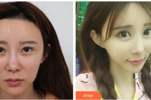 唐山艾玲醫(yī)療美容診所謝艾玲整形價格表附激光美膚激光案例展示