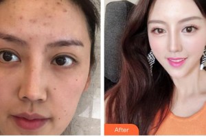 唐山惠美登醫(yī)療美容醫(yī)院瓦曼整形價格表附超聲提拉案例展示