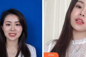武漢愛齒爾口腔門診部周先明整形價(jià)格表附牙齒矯正案例展示