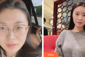 海口東湖醫(yī)學美容整形醫(yī)院李堅整形價格表附自體脂肪填充案例展示
