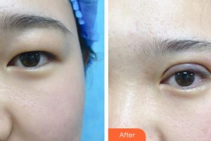 秦皇島紀(jì)輝整形美容醫(yī)院王雷整形價格表附眼部綜合案例展示