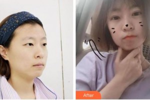 秦皇島念奴嬌醫(yī)療美容門診部康凱整形價(jià)格表附切開(kāi)雙眼皮案例展示