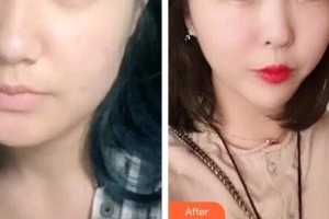 秦皇島東方皮膚醫(yī)學(xué)門診部馬嚴(yán)整形價格表附埋線提升案例展示