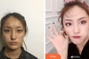 唐山星光醫(yī)療美容門診部白玲整形價(jià)格表附去痘印痘坑案例展示