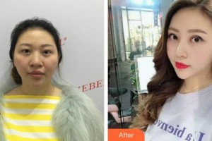 邯鄲愛爾眼科醫(yī)院梁玉珍整形價(jià)格表附鼻部綜合案例展示