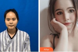 邯鄲現(xiàn)代麗人醫(yī)院整形美容中心李靈玲整形價(jià)格表附肋軟骨隆鼻案例展示