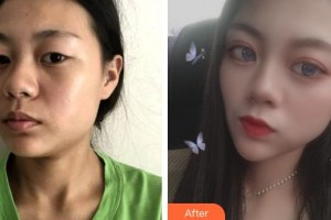 邯鄲雅乾醫(yī)療美容診所侯勝濤整形價格表附眼部綜合案例展示
