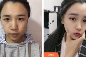 邯鄲雅乾醫(yī)療美容診所侯德勝整形價(jià)格表附眼部綜合案例展示