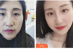邯鄲雅麗醫(yī)療美容門診部張子建整形價(jià)格表附埋線提升案例展示