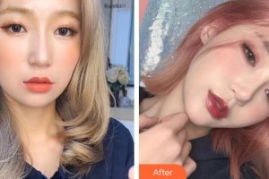 邢臺人民醫(yī)院醫(yī)學美容科張玉整形價格表附埋線提升案例展示