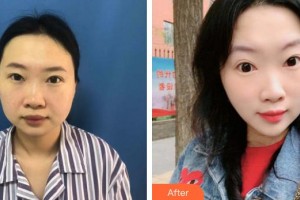 邢臺王桂華醫(yī)療美容診所王桂華整形價格表附切開雙眼皮案例展示