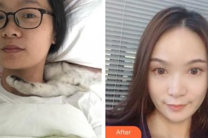 保定華仁皮膚病醫(yī)院激光美容中心劉敬整形價格表附埋線提升案例展示