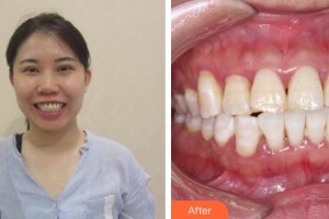 保定華美整形美容醫(yī)院朱紀(jì)國整形價格表附牙齒隱形矯正案例展示