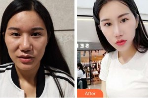 保定藍山醫(yī)療美容醫(yī)院于慧整形價格表附切開雙眼皮案例展示