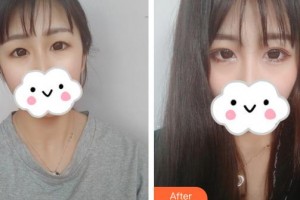 保定新視眼科醫(yī)院李金堂整形價格表附眼部綜合案例展示