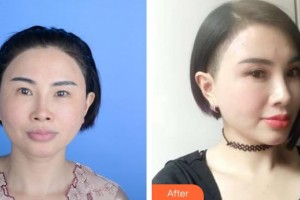 保定新視眼科醫(yī)院王穎整形價格表附切開雙眼皮案例展示