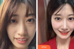 中山美南華整形美容醫(yī)院于建剛整形價格表附牙齒矯正案例展示