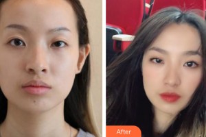 中山大學附屬第三醫(yī)院整形美容中心白莉整形價格表附植發(fā)案例展示