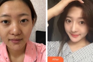 中山美爾醫(yī)療美容門診部周琮鎮(zhèn)整形價格表附鼻部手術(shù)案例展示