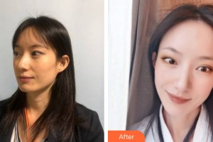 哈爾濱禾力康醫(yī)療美容醫(yī)院常維國整形價格表附皮膚美容案例展示