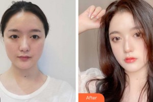 哈爾濱伊美爾醫(yī)療美容醫(yī)院張靜濤整形價格表附眼部手術(shù)案例展示