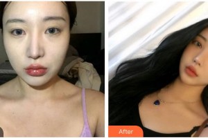 承德玥萊美醫(yī)療美容醫(yī)院孫喜平整形價(jià)格表附眼部綜合案例展示