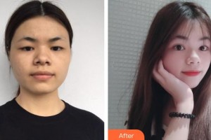承德愛(ài)爾眼科醫(yī)院梁信豪整形價(jià)格表附切開(kāi)雙眼皮案例展示