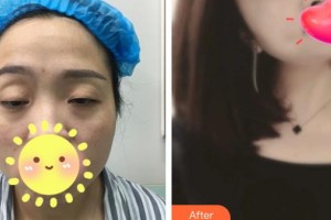 承德美天醫(yī)療美容醫(yī)院郭東超整形價(jià)格表附上瞼提肌案例展示