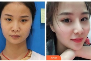 滄州龐大夫醫(yī)療美容診所龐麗娜整形價格表附假體隆鼻案例展示