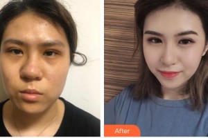 滄州瑞美醫(yī)療美容門(mén)診部牛永敢整形價(jià)格表附假體隆鼻案例展示