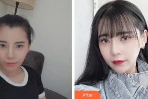 滄州瑞美醫(yī)療美容門(mén)診部王厲整形價(jià)格表附鼻部綜合案例展示