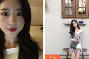 滄州靜港醫(yī)療美容診所宋錦榮整形價格表附鼻部綜合案例展示