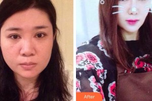 滄州市人民醫(yī)院燒傷整形科李勇整形價格表附假體隆鼻案例展示