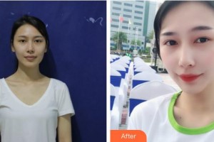 滄州眼科醫(yī)院王彥整形價格表附眼部綜合案例展示