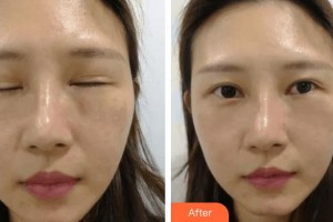 滄州眼科醫(yī)院賈洪強(qiáng)整形價格表附內(nèi)切祛眼袋案例展示