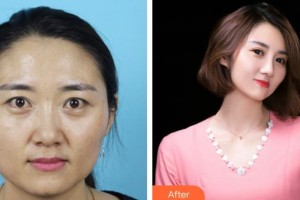 廊坊頤美佳醫(yī)療美容醫(yī)院尹寧北整形價格表附眼部綜合案例展示