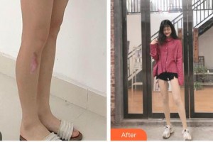 衡水瑞美醫(yī)療美容門診部杜軼男整形價格表附激光祛疤案例展示