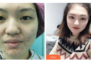 衡水愛爾眼科醫(yī)院彭永奎整形價(jià)格表附眼部綜合案例展示