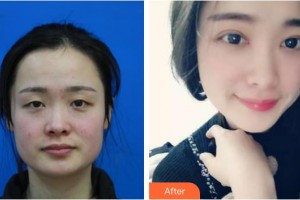 衡水愛爾眼科醫(yī)院胡連潤(rùn)整形價(jià)格表附眼部綜合案例展示