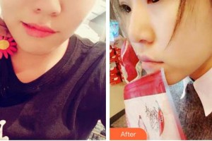 山西醫(yī)科大學(xué)附屬太鋼總醫(yī)院燒傷整形中心郝振明整形價(jià)格表附光子嫩膚案例展示