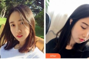 山西醫(yī)科大學附屬太鋼總醫(yī)院燒傷整形中心趙志偉整形價格表附彩光嫩膚案例展示