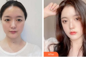 蘭州嘉琳醫(yī)學美容醫(yī)院劉志剛整形價格表附眼部手術案例展示