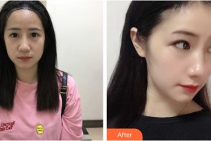 蘭州韓美整形美容醫(yī)院吳珉整形價格表附植發(fā)案例展示