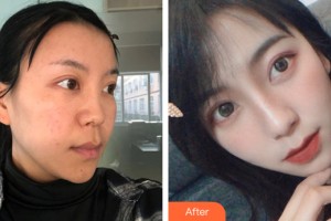 蘭州明倫醫(yī)療美容門診部馮建業(yè)整形價格表附隆鼻手術案例展示