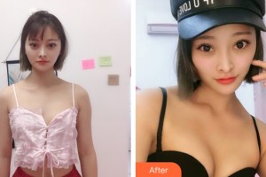 蘭州海惠醫(yī)療美容門診部莊成全整形價(jià)格表附隆胸手術(shù)案例展示