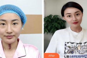 山西省眼科醫(yī)院唐桂蘭整形價格表附切開雙眼皮案例展示
