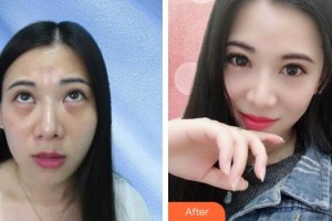 山西省眼科醫(yī)院劉剛整形價格表附內切祛眼袋案例展示